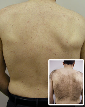 computer-guided-hair-removal-back