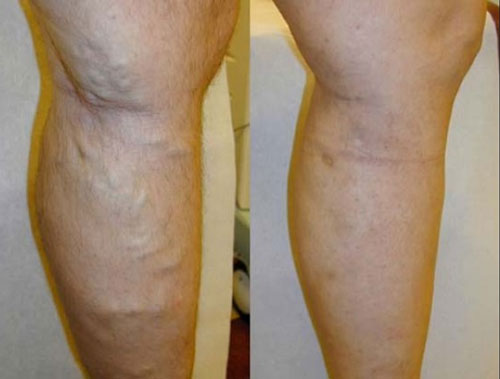 EVLT Treatment | Amarillo, TX | Endovenous Laser Treatment