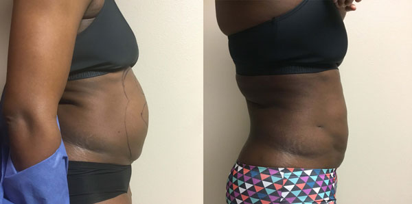 laser-lipo-before-&-after-photo-side2