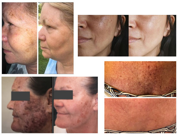 pigmentations-rosacea-b&a-photos-mobile