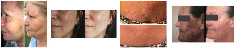 pigmentations-rosacea-b&a-photos