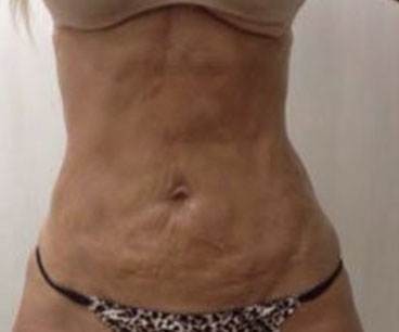 tribella-before-front-body-photo