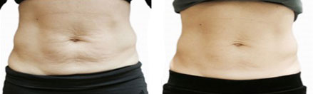 venus-versa-before-&-after-stomach